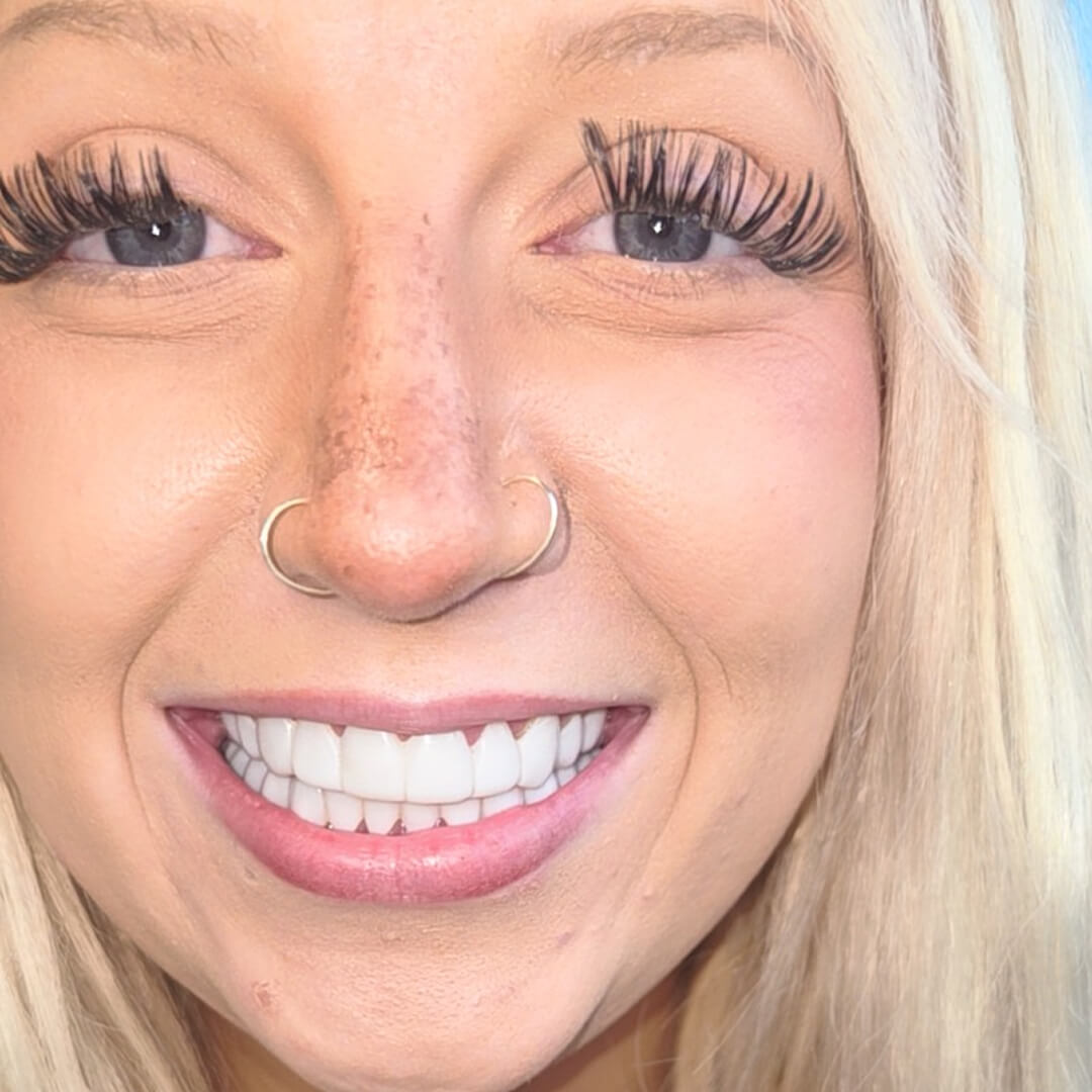 Shiny Smile Snap-On Veneers