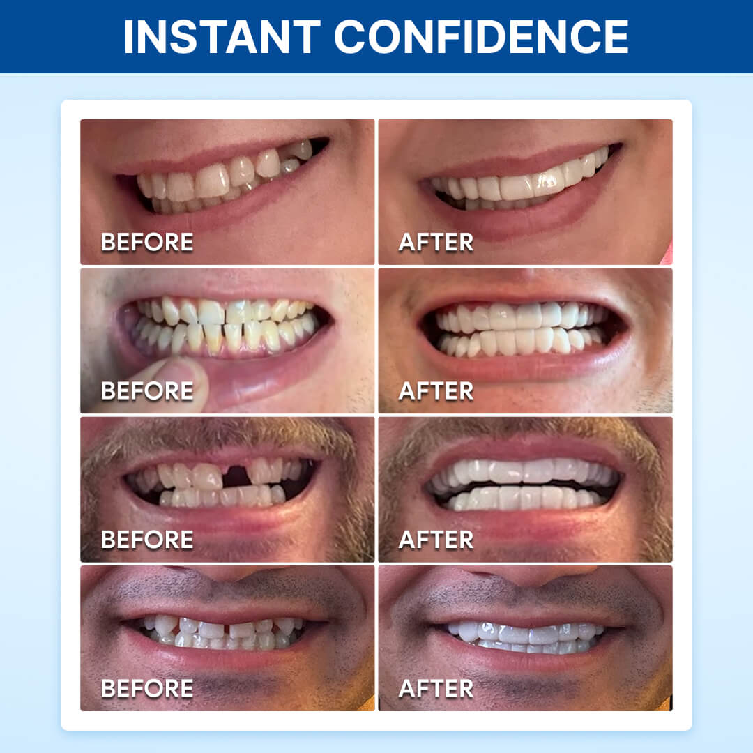 Shiny Smile Snap-On Veneers