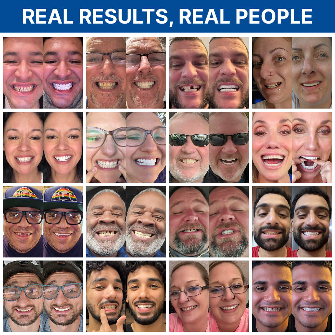 Shiny Smile Snap-On Veneers
